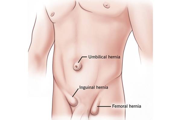Types hernia